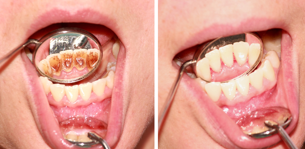 Zuby pacienta pred a po absolvovaní dentálnej hygieny.