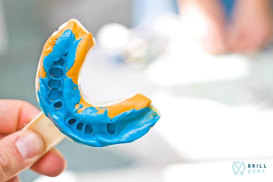 Odtlačky zubov: Kedy ich potrebujeme a ako sa robia?