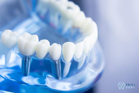 Výhody zubných implantátov