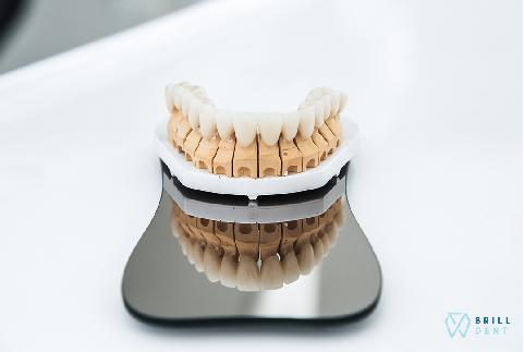 Zubný mostík na implantátoch: Je lepší ako klasický?