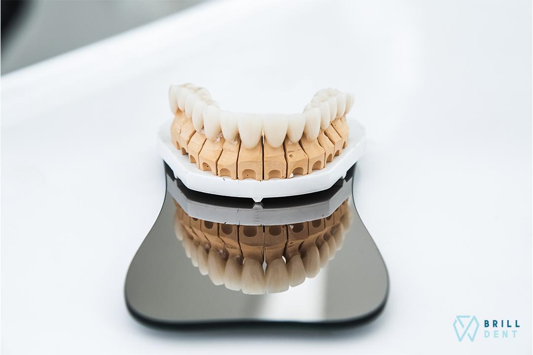 obr: Zubný mostík na implantátoch: Je lepší ako klasický?